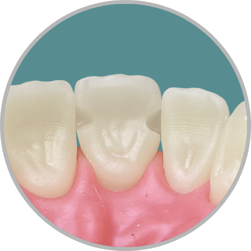 Dente 21 - Classe III (M) e (D) (cod:21.L)