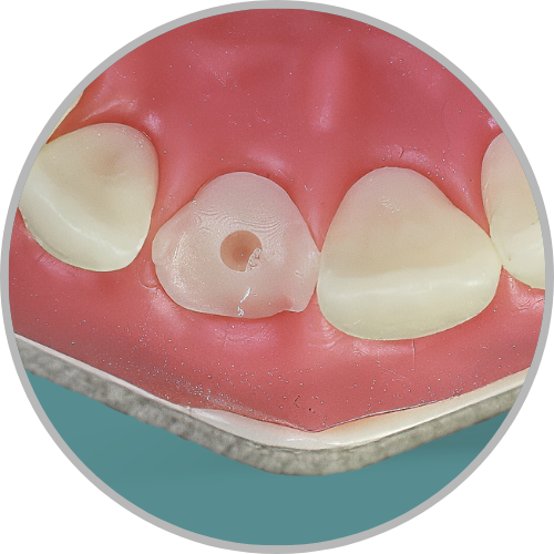 Dente 21 - Coto dental a nível de gengiva com preparo para retentor intra radicular (cod:21.N)