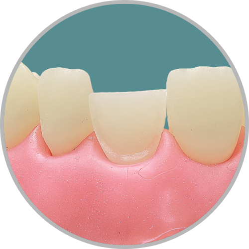 Dente 21 - Preparo para faceta com redução incisal (cod:21.P)