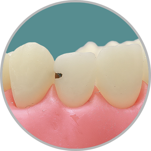 Dente 22 - Lesão de cárie classe III (VDP) (cod:22.B)