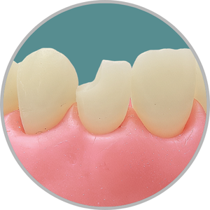 Dente 22 - Classe IV (D) (cod:22.E)