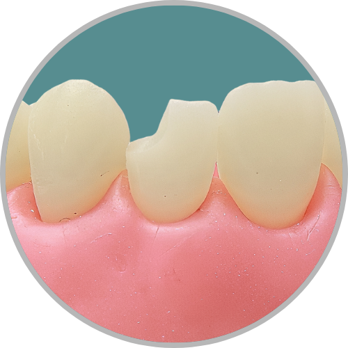 Dente 22 - Classe IV (D) (cod:22.E)