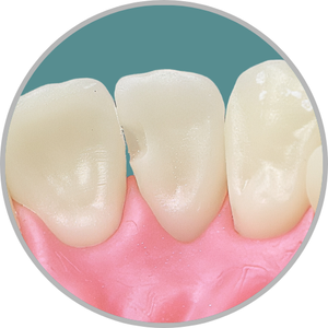 Dente 22 - Classe III (MP) e (DV) (cod:22.F)