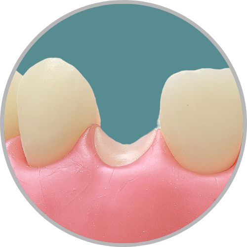 Dente 22 - Coto dental a nível de gengiva (cod:22.G)