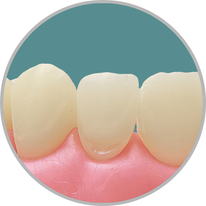 Dente 22 - Classe V (V) (cod:22.I)