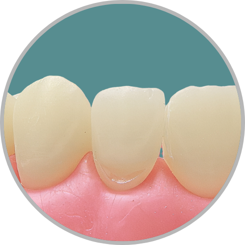 Dente 22 - Classe V (V) (cod:22.I)