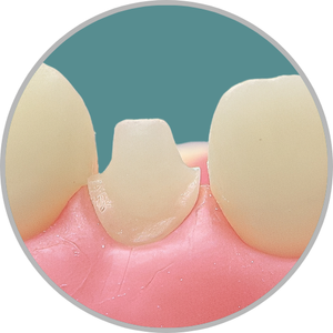 Dente 22 - Coroa Total (cod:22.J)