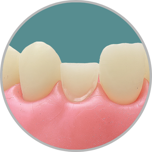 Dente 22 - Preparo para faceta com redução incisal (cod:22.K)