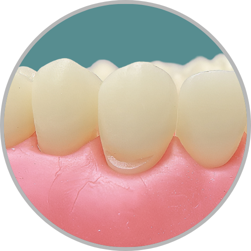 Dente 23 - Classe V (V) (cod:23.A)