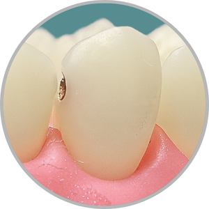 Dente 23 - Lesão de cárie classe III (D) com exposição polpar (cod:23.B)