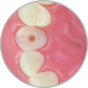 Dente 23 - Coto dental à nível de gengiva com conduto preparado (cod:23.D)