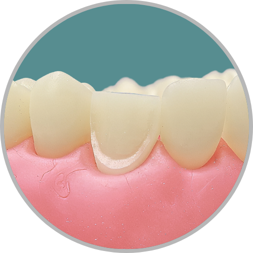 Dente 23 - Perda da borda incisal com preparo para faceta no remanescente (cod:23.E)