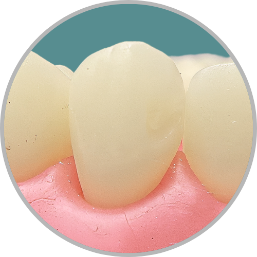 Dente 23 - Classe III (MV) (cod:23.G)