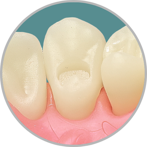 Dente 23 - Classe I (O) (cod:23.H)