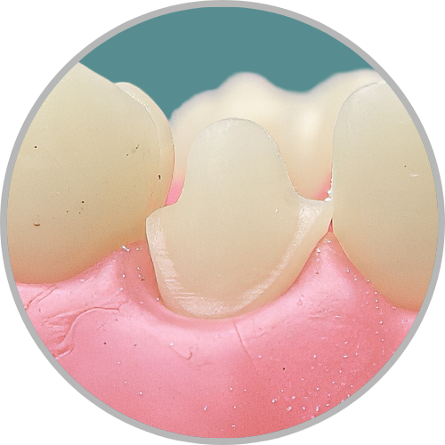 Dente 23 - Coroa Total (cod:23.J)