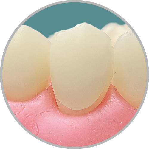Dente 23 - Preparo para faceta com redução incisal (cod:23.K)