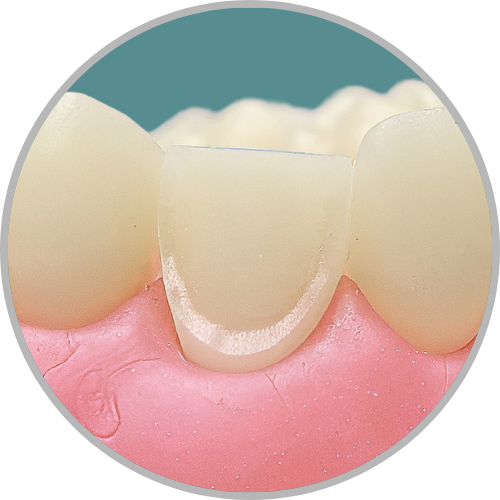 Dente 23 - Preparo para faceta com redução incisal (cod:23.K)
