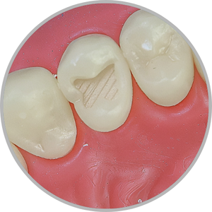 Dente 24 - Classe I (O) (cod:24.A)