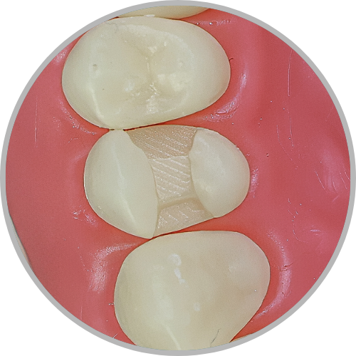 Dente 24 - Classe II (MOD) (cod:24.B)