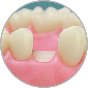 Dente 24 - Coto dental a nível de gengiva (cod:24.C)