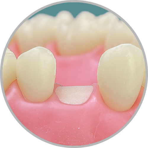 Dente 24 - Coto dental a nível de gengiva (cod:24.C)