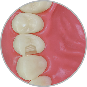 Dente 24 - Classe II (MO) (cod:24.D)