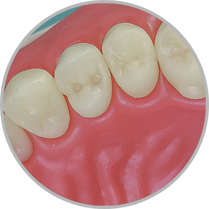 Dente 24 - Classe I em 2 pontos (cod:24.E)