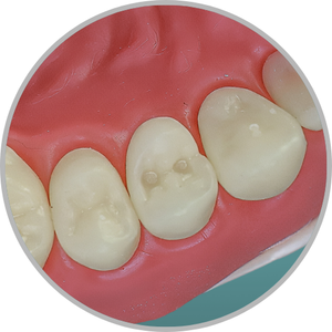 Dente 24 - Classe I em 2 pontos (cod:24.E)