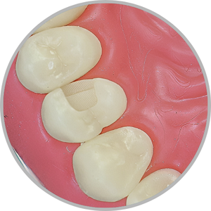 Dente 24 - Classe II (OD) (cod:24.F)