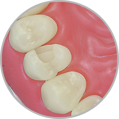 Dente 24 - Classe II (OD) (cod:24.F)