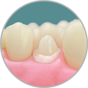 Dente 24 - Coroa Total (cod:24.G)
