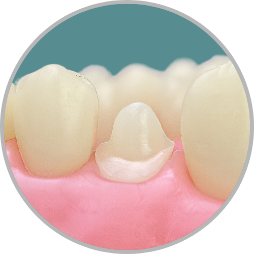 Dente 24 - Coroa Total (cod:24.G)