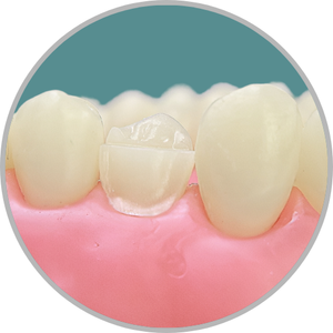 Dente 24 - Preparo para faceta com redução incisal (cod:24.H)