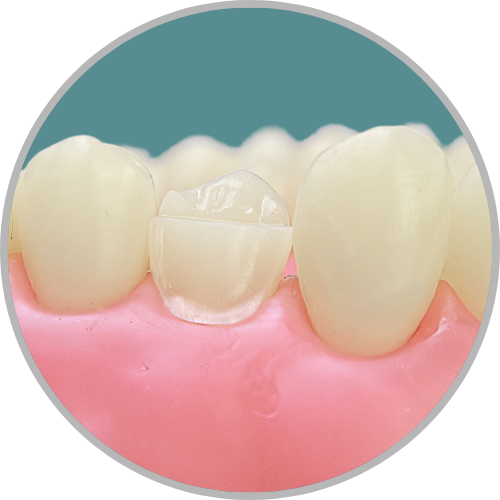 Dente 24 - Preparo para faceta com redução incisal (cod:24.H)