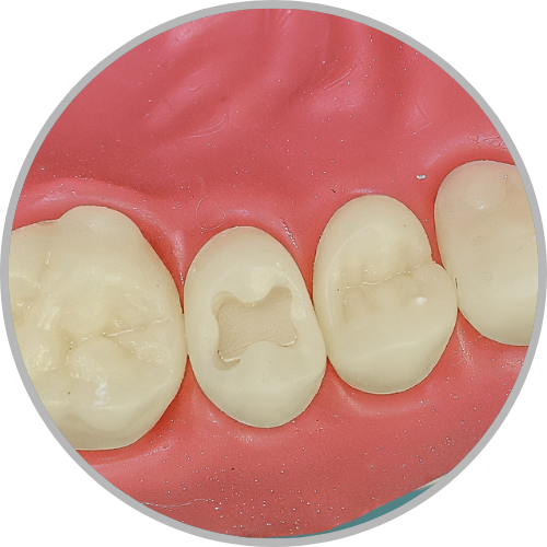 Dente 25 - Classe I (O) (cod:25.A)