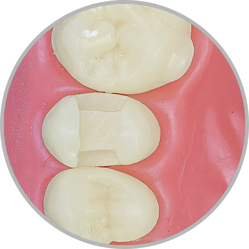 Dente 25 - Classe II (MOD) (cod:25.C)