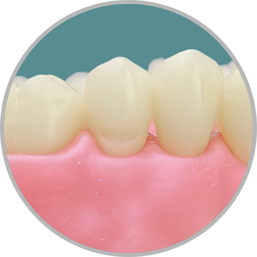 Dente 25 - Classe II (MOD) e Classe V (V) (cod:25.D)