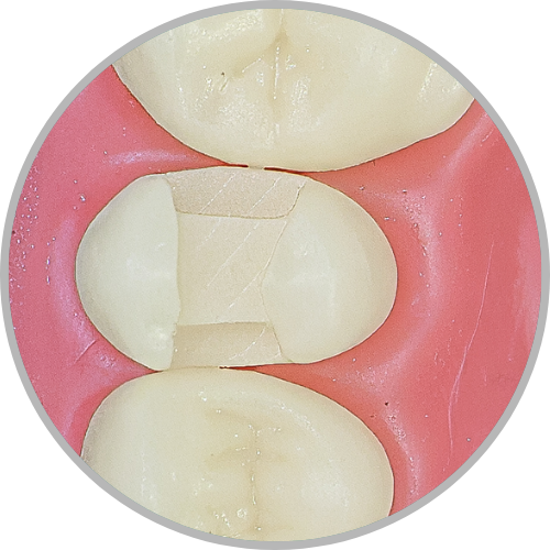 Dente 25 - Classe II (MOD) e Classe V (V) (cod:25.D)