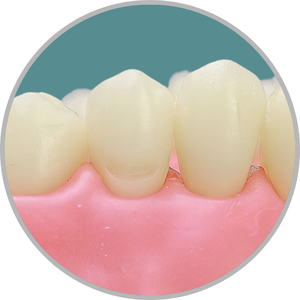 Dente 25 - Classe I (O) e Classe V (V) (cod:25.E)