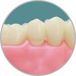 Dente 25 - Classe V (V) (cod:25.F)