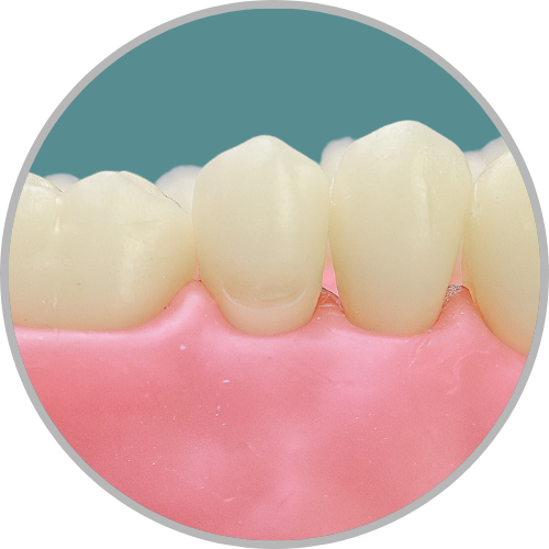 Dente 25 - Classe V (V) (cod:25.F)