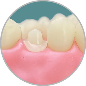 Dente 25 - Coroa Total (cod:25.G)