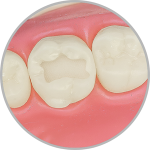 Dente 26 - Classe I (O) (cod:26.A)