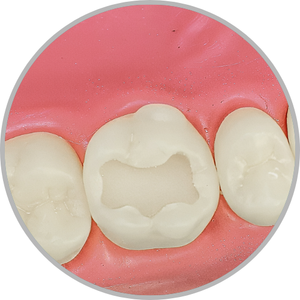 Dente 26 - Classe I (O) e Classe V (V e P) (cod:26.B)