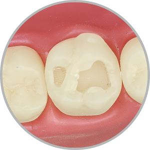 Dente 26 - Classe I (O) em 2 pontos com prservação da ponte de esmalte (cod:26.C)