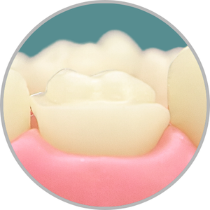 Dente 26 - Overlay (cod:26.E)