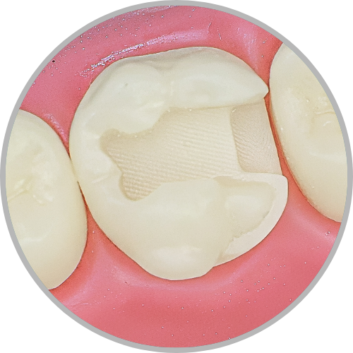 Dente 26 - Classe II (ODL) com proteção cuspídea na cuspide DP (cod:26.G)