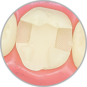 Dente 26 - Classe II (MODP) com proteção cuspídea na cuspide MP (cod:26.H)