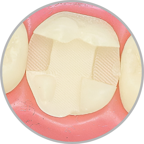 Dente 26 - Classe II (MODP) com proteção cuspídea na cuspide MP (cod:26.H)