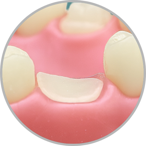 Dente 26 - Coto dental a nível de gengiva (cod:26.I)
